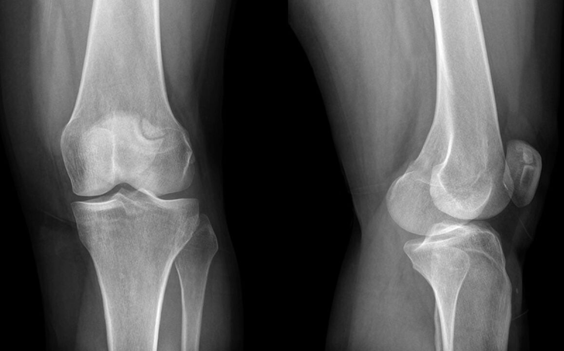 L'arthrose du genou à la ligne X avant l'utilisation du hondroine
