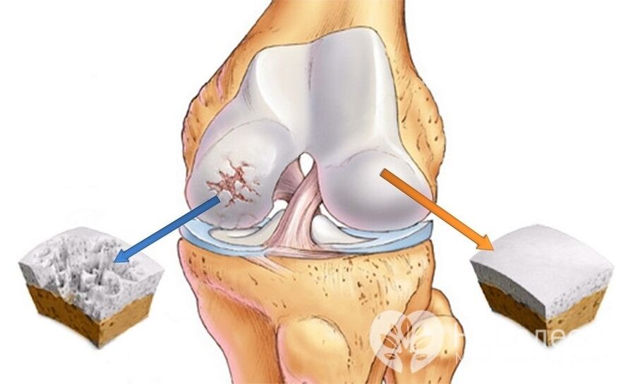 Arthrose du genou