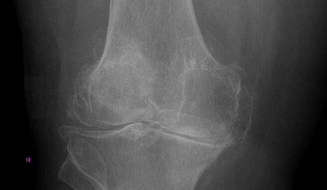 Diagnostic d'arthrose