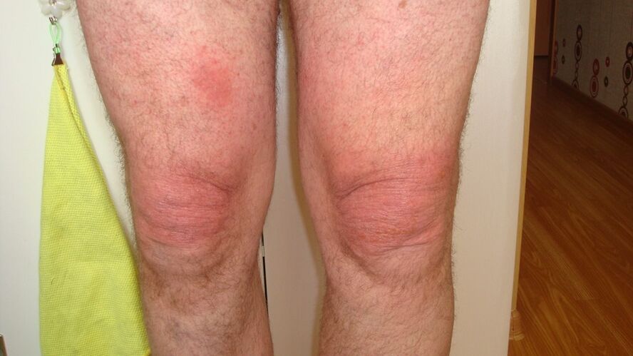 arthrose des articulations du genou.