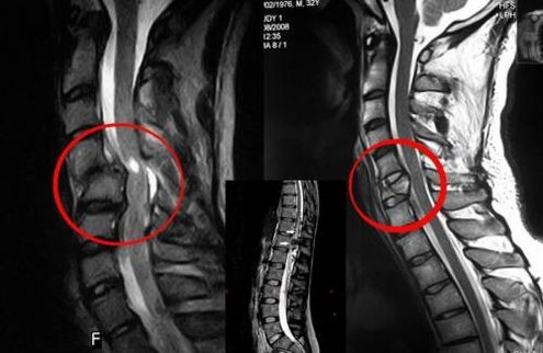 Indication chirurgicale de compression de la moelle épinière